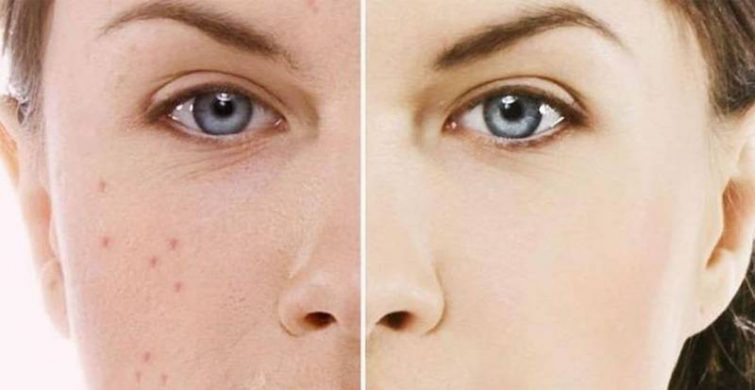 Рецепты против угревой сыпи и прыщей на лице