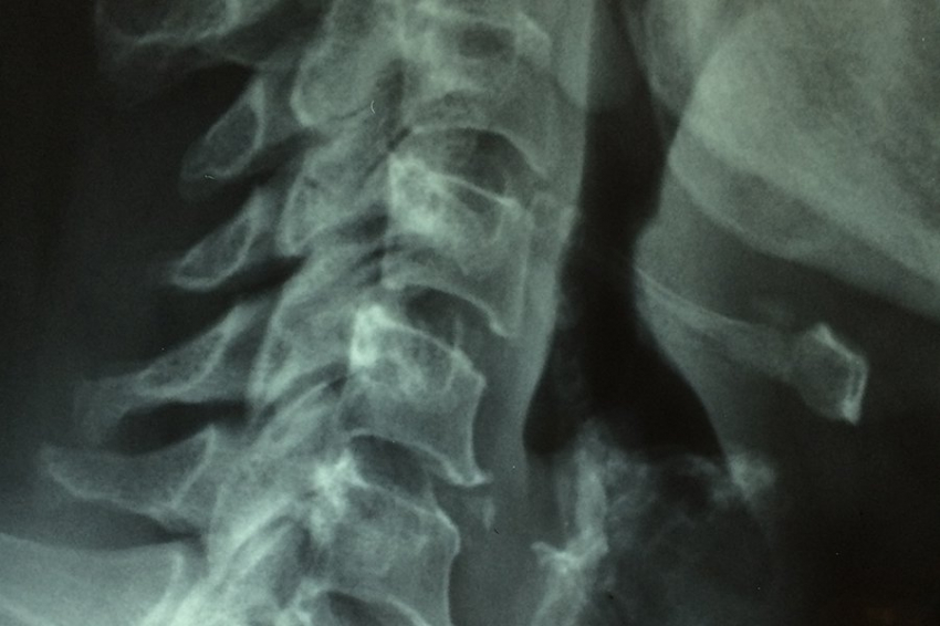Образование рубцов после травмы спинного мозга оказалось более сложным процессом