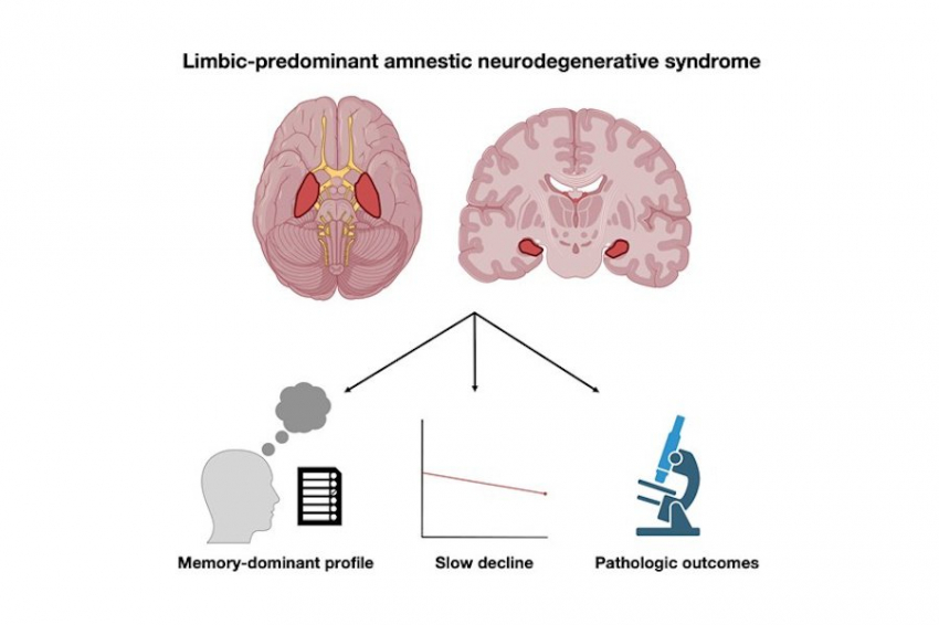 Новый взгляд на потерю памяти представили неврологи из клиники Майо