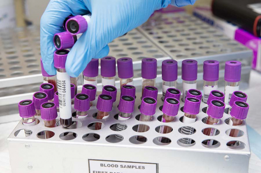 Новый анализ крови улучшает раннее выявление рака поджелудочной железы